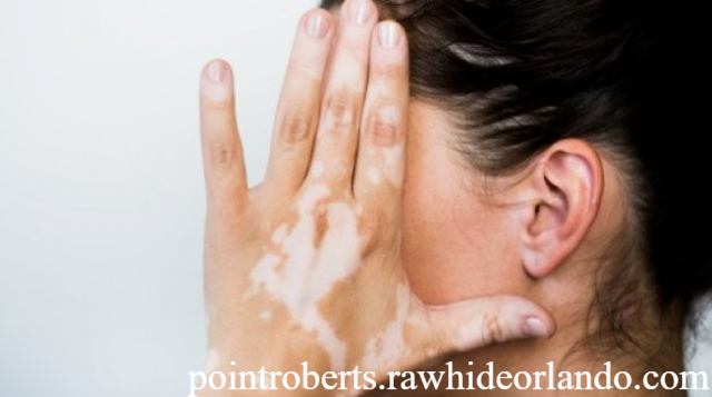 Kenali Gejala Awal Kusta: Bercak Putih yang Sering Dikira Panu